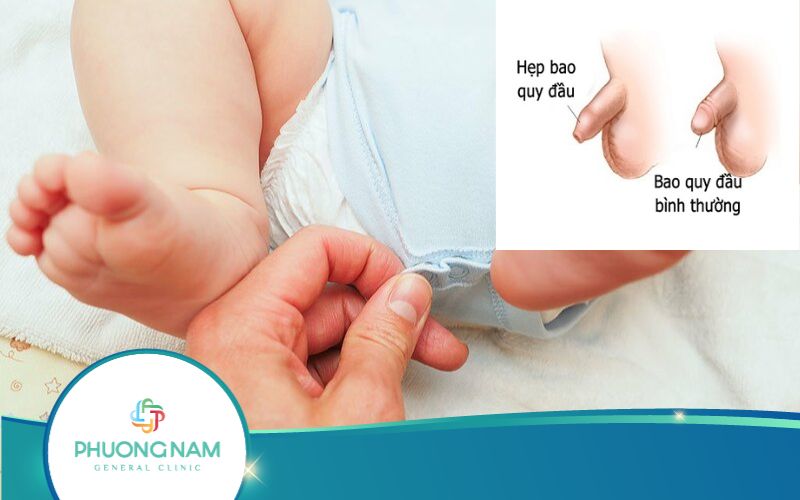 Trẻ Sơ Sinh Bị Hẹp Bao Quy Đầu Phải Làm Sao?