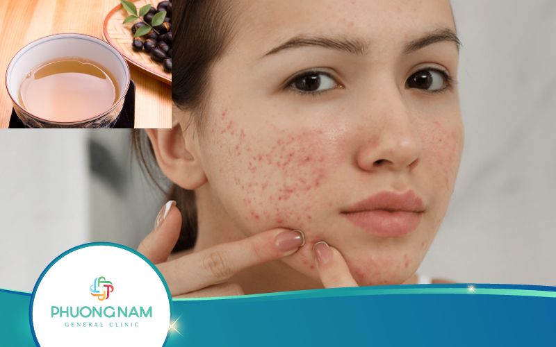 Nước Đậu Đen Rang Trị Mụn Có Hiệu Quả Không?