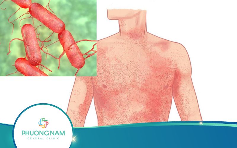 Bị Cảm Thương Hàn Biến Chứng Gồm Những Gì?