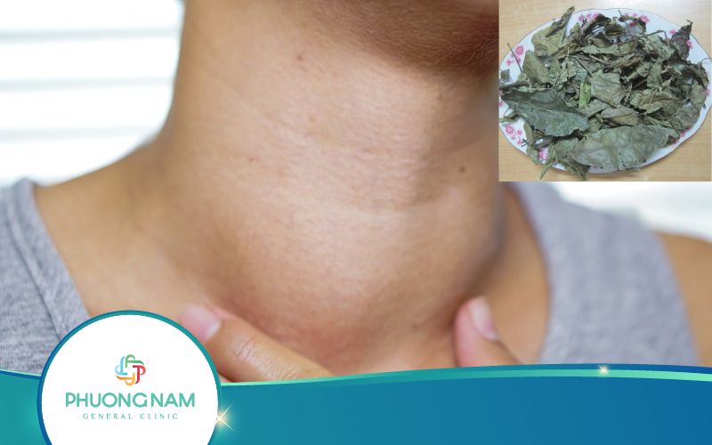 Vì Sao Dùng Cây Xạ Đen Chữa Bướu Cổ? Hiệu Quả Không?