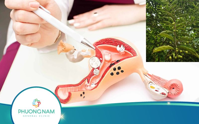 Cây Xạ Đen Chữa U Xơ Tử Cung Như Thế Nào?