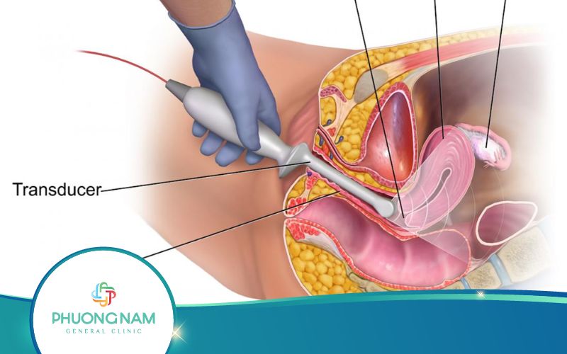 Siêu Âm Đầu Dò Âm Đạo Là Gì? Quy Trình Thực Hiện Ra Sao?