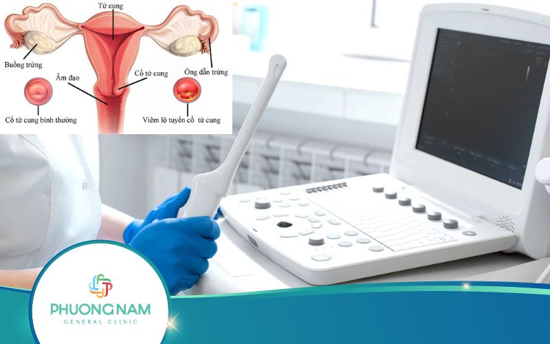 Siêu Âm Đầu Dò Có Phát Hiện Viêm Lộ Tuyến Không?