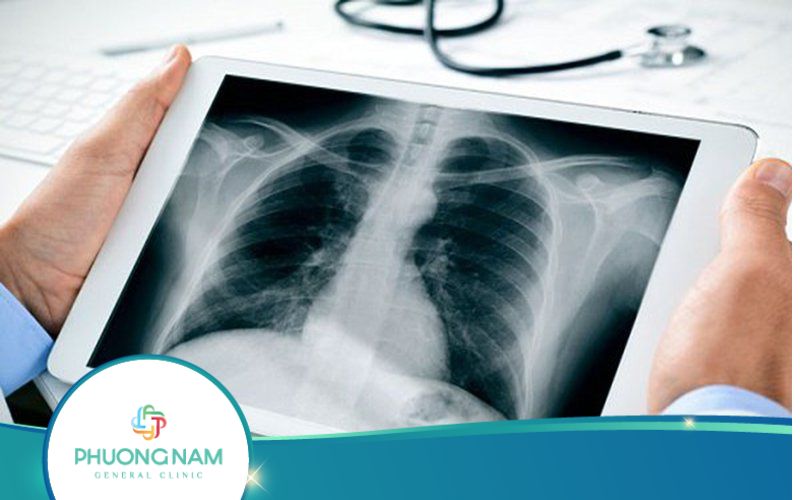 Chụp X-quang Phổi Hết Bao Nhiêu Tiền?