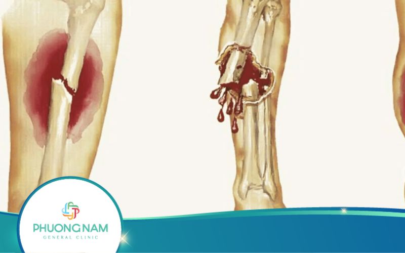 Chụp X Quang Khớp Gối Giúp Chẩn Đoán Được Bệnh Gì?