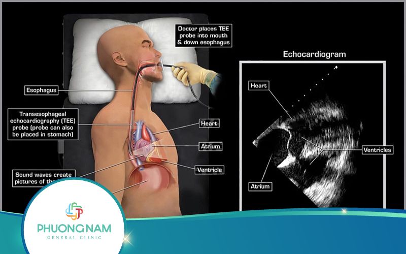 Hướng Dẫn Đọc Kết Quả Siêu Âm Tim