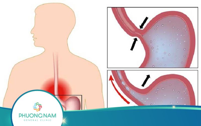 Nội Soi Dạ Dày Có Biết Được Hở Van Dạ Dày Không?
