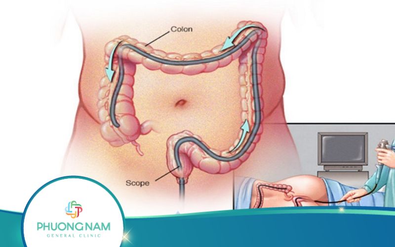 Nội Soi Đại Tràng Có Bị Lây Bệnh Không?