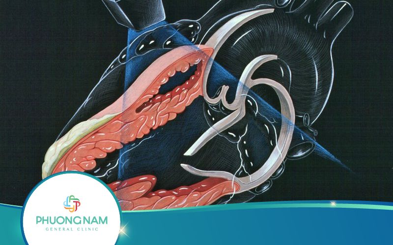 Tất Tần Tật Thông Tin Về PAP Siêu Âm Tim