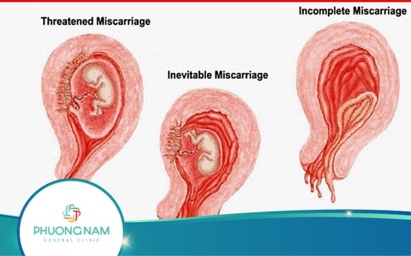 Siêu Âm Có Dịch Trong Tử Cung Phải Làm Gì?