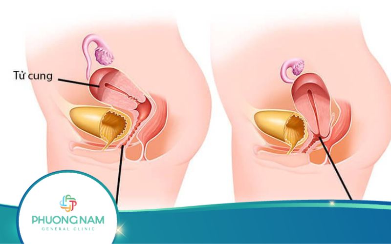 Siêu Âm Có Phát Hiện Sa Tử Cung Không?