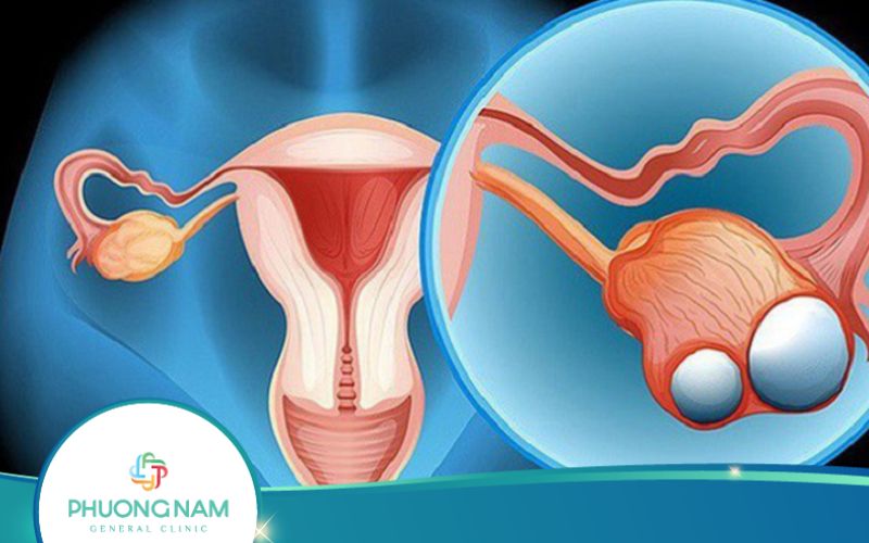 Siêu Âm Có Phát Hiện Ung Thư Buồng Trứng Không?