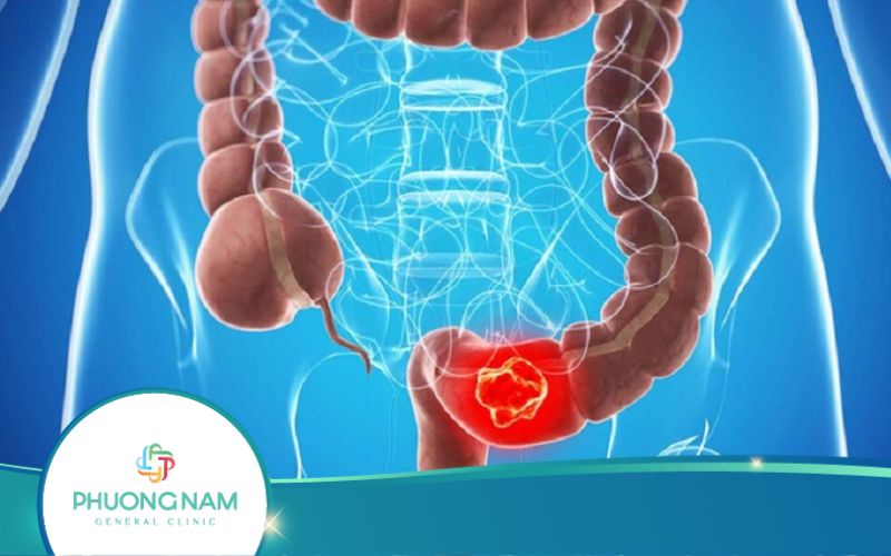 Siêu Âm Có Phát Hiện Ung Thư Đại Tràng Không?
