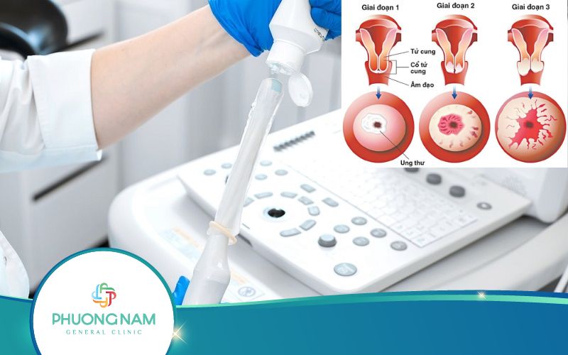 Siêu Âm Đầu Dò Có Phát Hiện Ung Thư Cổ Tử Cung Không?