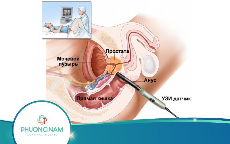 Khi Nào Thực Hiện Siêu Âm Đầu Dò Trực Tràng?