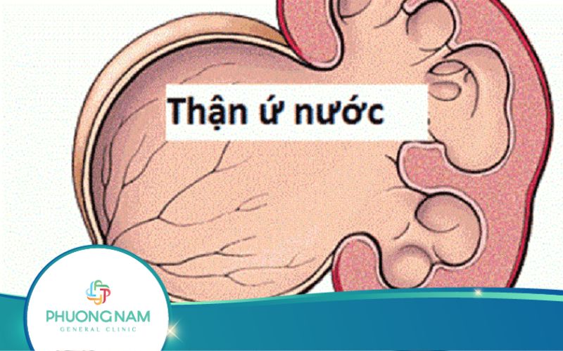 Siêu Âm Thận Ứ Nước Cho Kết Quả Như Thế Nào?