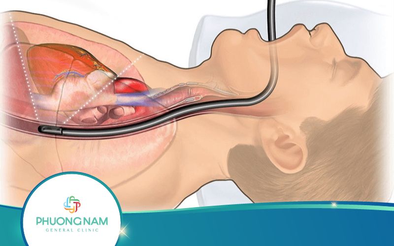 Siêu Âm Tim Qua Thực Quản Là Gì? Có Đau Không?