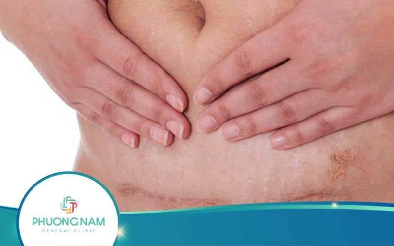 Siêu Âm Vết Mổ Sau Sinh Và Các Biến Chứng Có Thể Xảy Ra