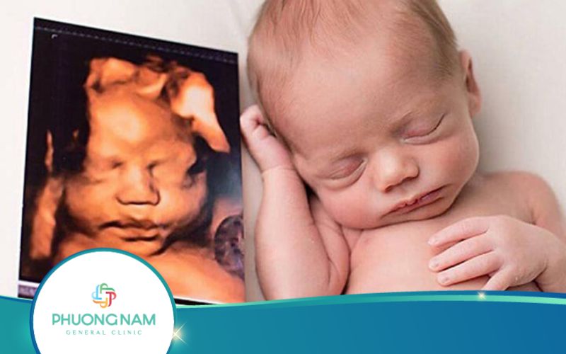 Thai 21 Tuần Siêu Âm 4D Nên Hay Không?