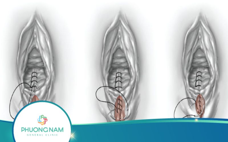 Bị Rách Môi Bé Thì Phải Làm Sao?