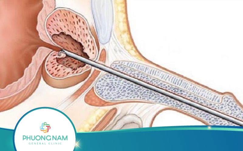 Phương Pháp Cắt Đốt Nội Soi Tiền Liệt Tuyến