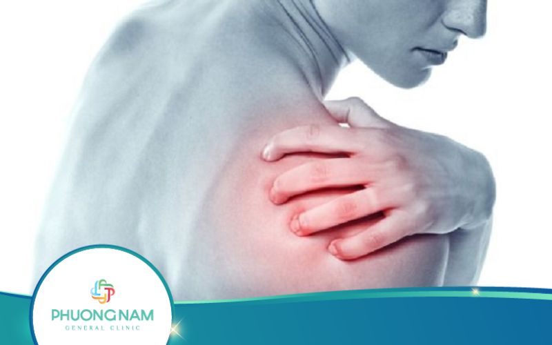Chi Phí Mổ Nội Soi Trật Khớp Vai Tái Hồi Bao Nhiêu?