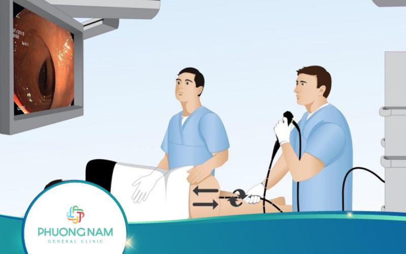 Khoảng Cách Giữa 2 Lần Nội Soi Đại Tràng Là Bao Lâu?