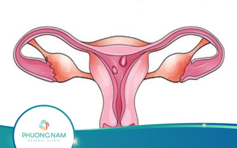 Quy Trình Mổ Nội Soi Cắt Polyp Buồng Tử Cung