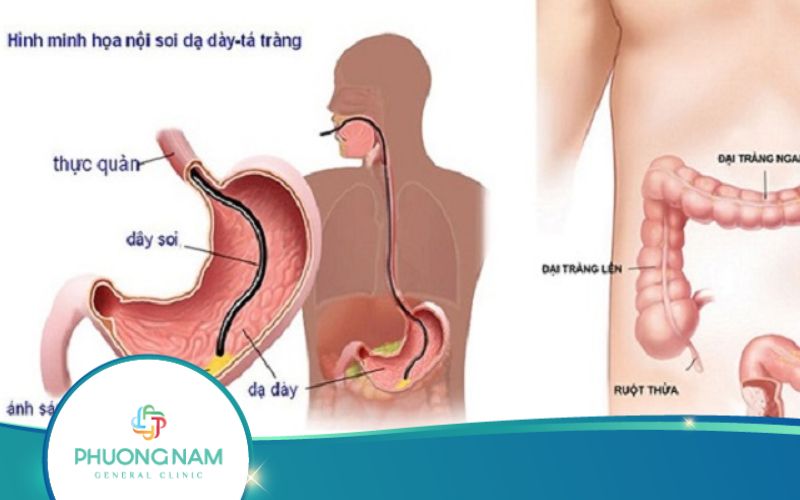 Nội Soi Dạ Dày Có Phát Hiện Được Ung Thư Không?