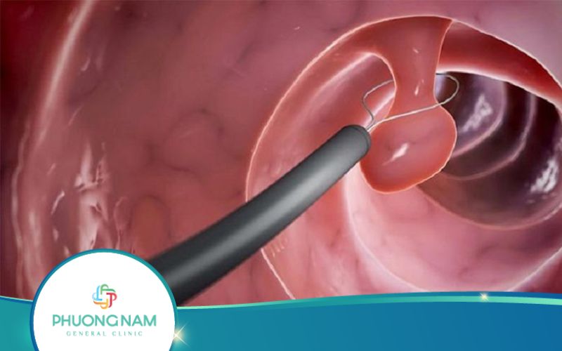 Nội Soi Dạ Dày Có Sinh Thiết Là Gì?