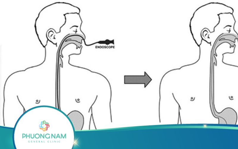 Nội Soi Dạ Dày Qua Đường Mũi Có Ưu Và Nhược Điểm Gì?