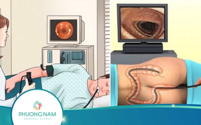Có Nên Nội Soi Dạ Dày Và Đại Tràng Cùng Lúc Không?
