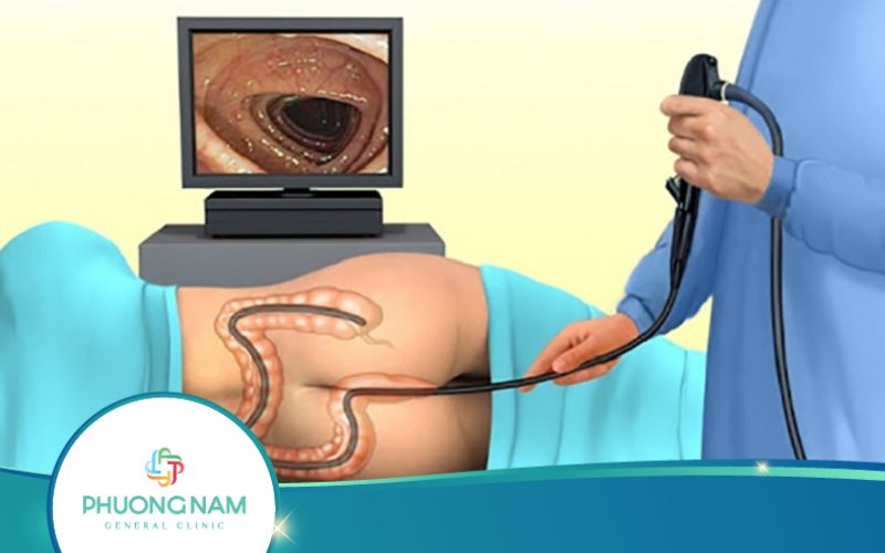 Nội Soi Đại Tràng Có Được Bảo Hiểm Chi Trả Hay Không?