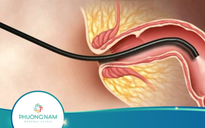 Nội Soi Trực Tràng Có Phải Nhịn Ăn Không?