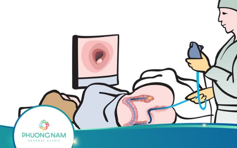 Nội Soi Trực Tràng Ống Mềm Không Sinh Thiết