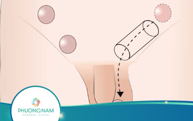Mổ Nội Soi Điều Trị Tinh Hoàn Ẩn