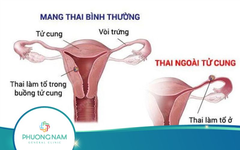 Khi Nào Mẹ Bầu Cần Mổ Nội Soi Thai Ngoài Tử Cung?