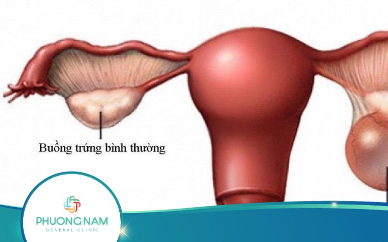 Mổ Nội Soi U Nang Buồng Trứng Bao Lâu Thì Lành?