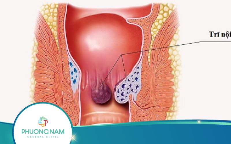 Quy Trình Nội Soi Bệnh Trĩ Được Thực Hiện Như Thế Nào?
