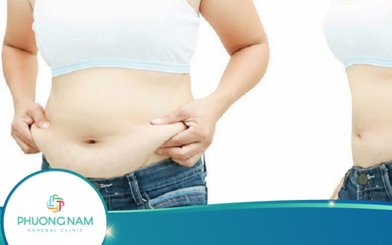 Có Nên Cấy Chỉ Giảm Béo Không?