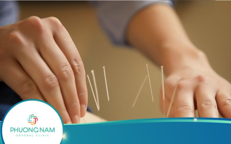 Châm Cứu Giảm Cân Có Thật Sự Hiệu Quả Không?