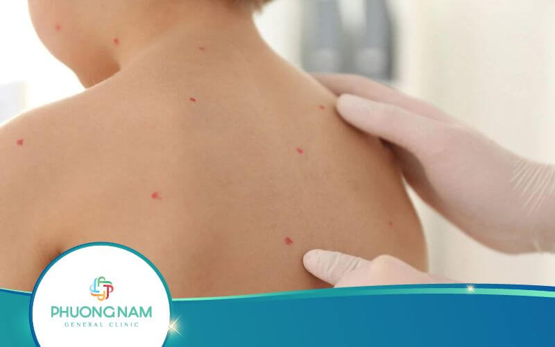Chăm Sóc Trẻ Bị Thủy Đậu Đúng Cách Cha Mẹ Nên Biết