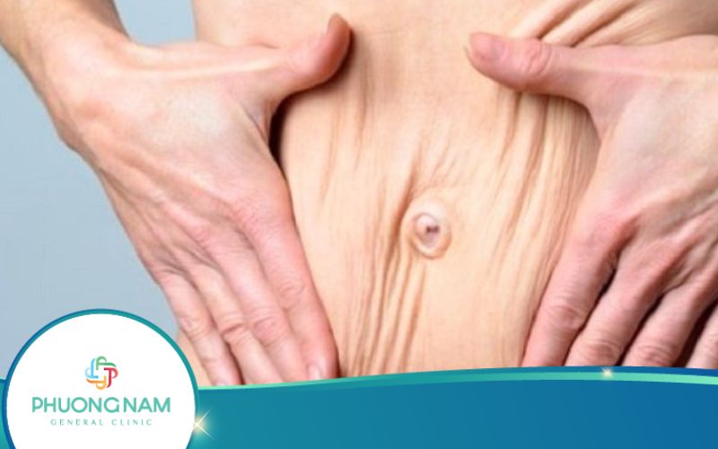 Làm Thế Nào Để Cải Thiện Tình Trạng Da Chảy Xệ Sau Giảm Cân?