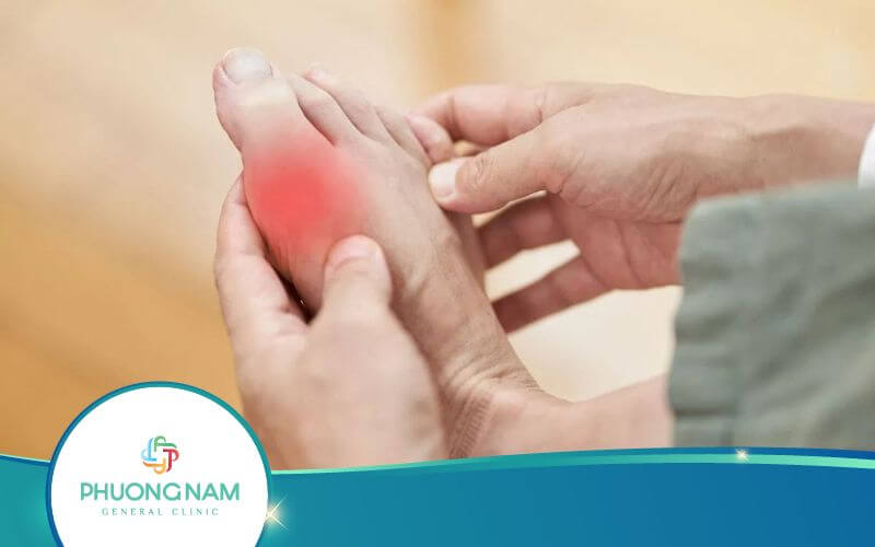 Bệnh Gout Có Chữa Khỏi Được Không?
