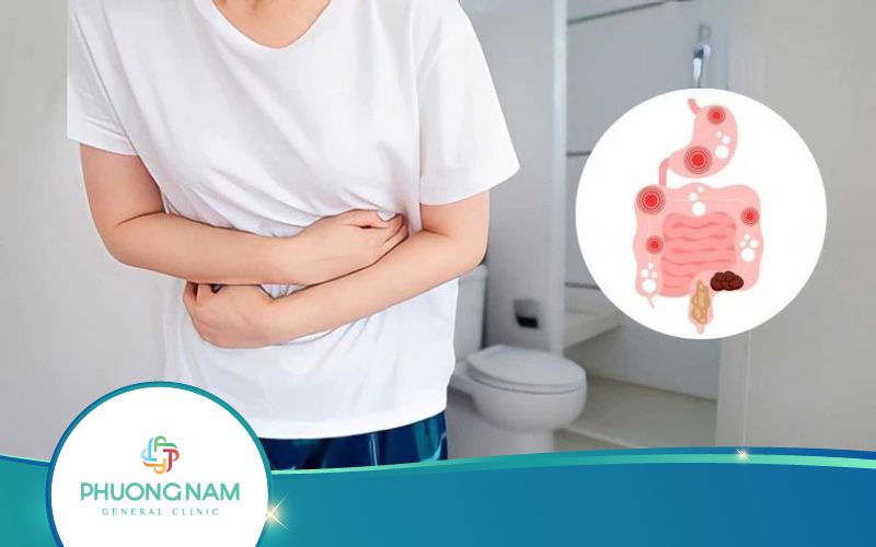 Cách Trị Hội Chứng Ruột Kích Thích Tại Nhà