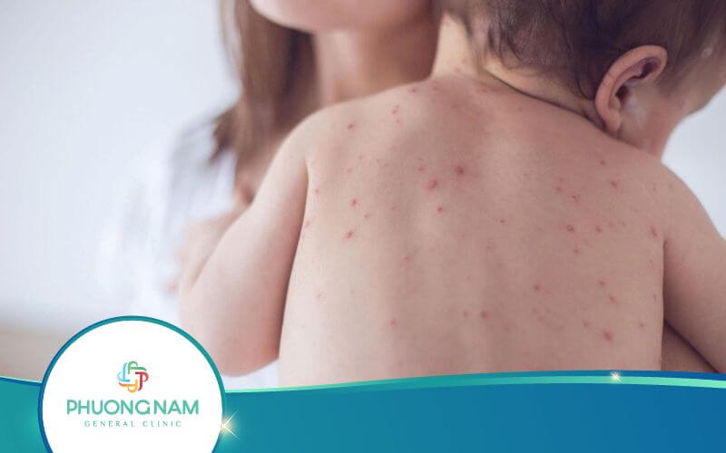 Dấu Hiệu Nhận Biết Bệnh Rubella – Nguyên Nhân, Cách Phòng Ngừa