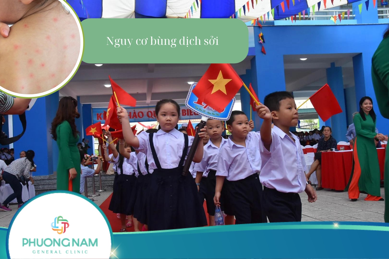 Bệnh sởi – Nguy cơ bùng dịch mùa tựu trường năm 2024