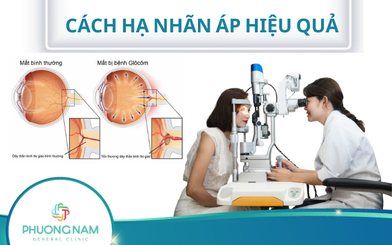 Hướng dẫn cách hạ nhãn áp hiệu quả, phổ biến hiện nay