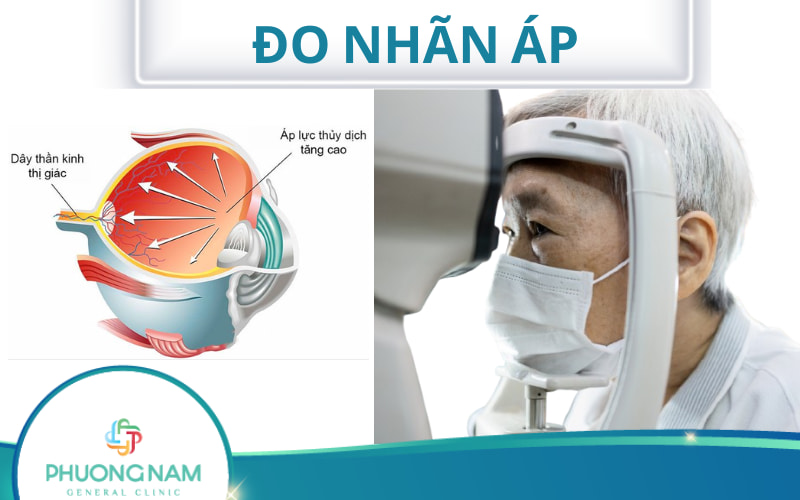 Đo nhãn áp là gì? Những ai cần thực hiện do nhãn áp?