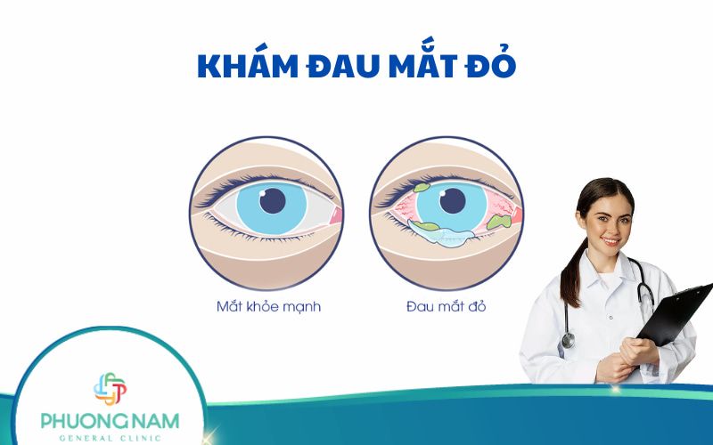 Tìm hiểu về khám đau mắt đỏ và điều trị đúng cách sớm
